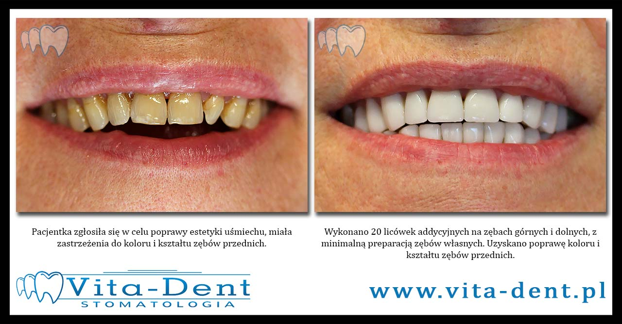 Additive veneers Wroclaw