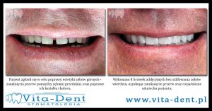 Additive veneers - Diastema closure