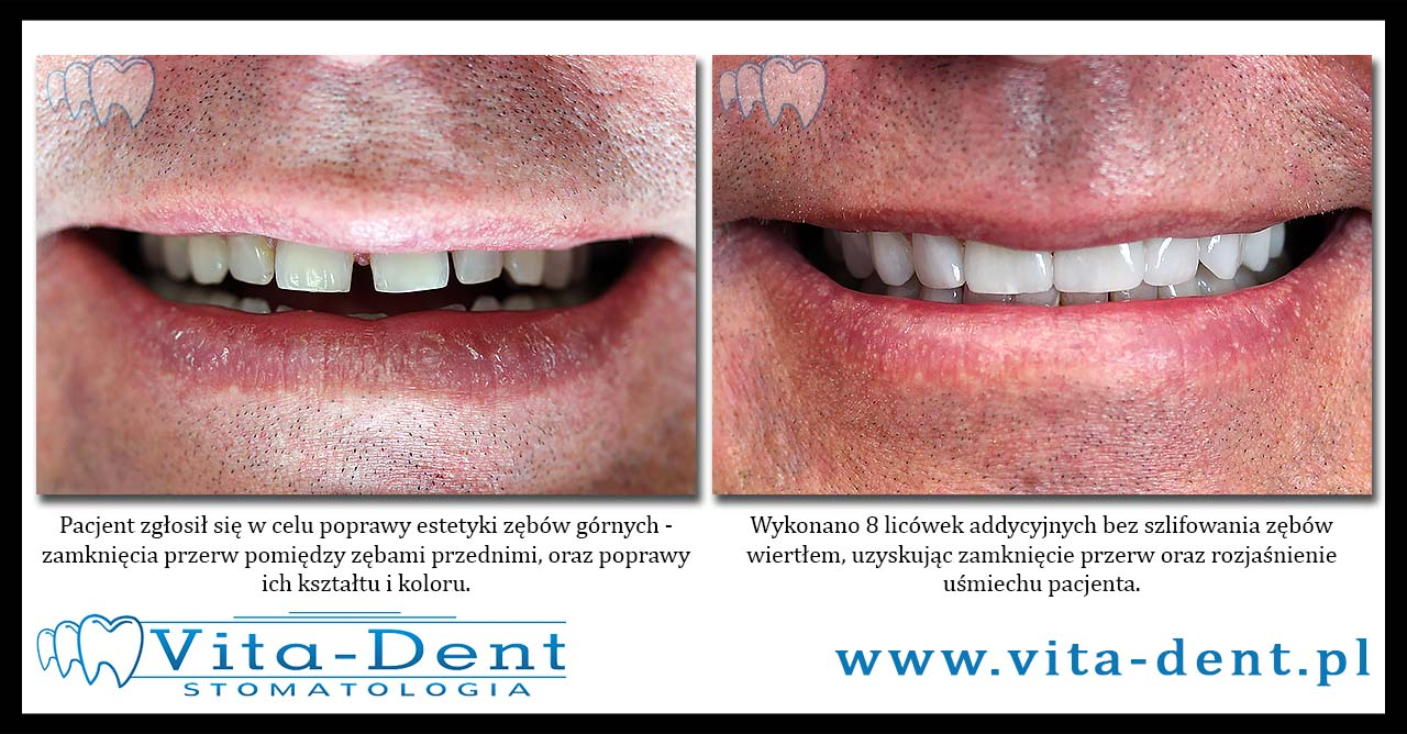 Additive veneers - Diastema closure