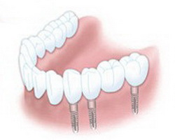 Mosty na implantach