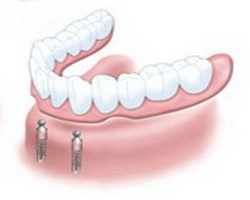 Prostheses on implants