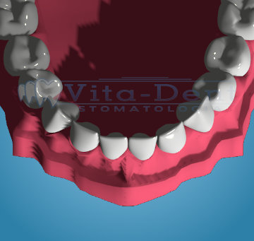 Verdrängung der unteren Zähne nach der Behandlung