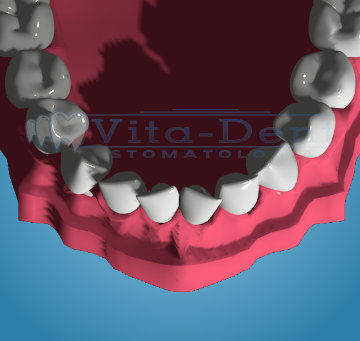 Stłoczenia zębów dolnych Ortodoncja