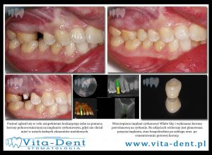 Zirconia implants - crown