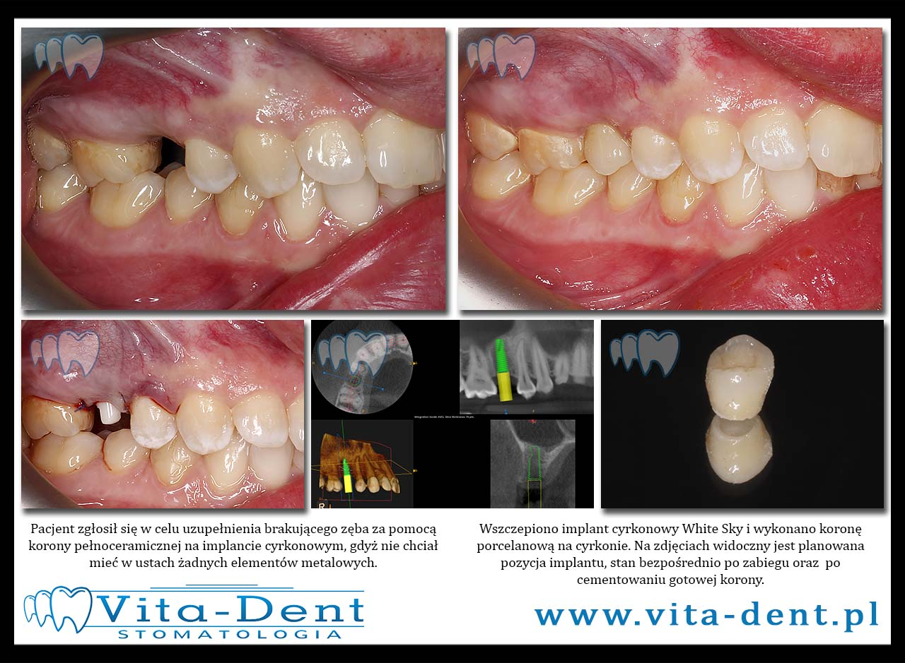 Zirkonoxid-Implantate - Krone