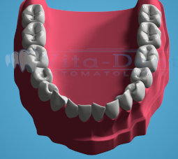 Light Tooth Crowding