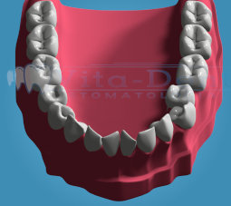 Moderate crowding of teeth