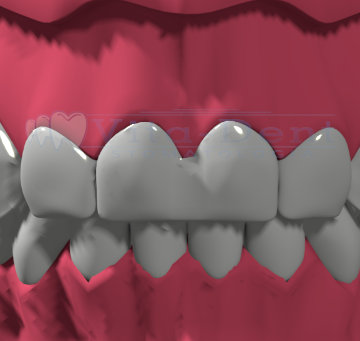 Flooded teeth - orthodontic treatment Wrocław