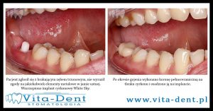 Zirconia implants, zirconia crown on implant