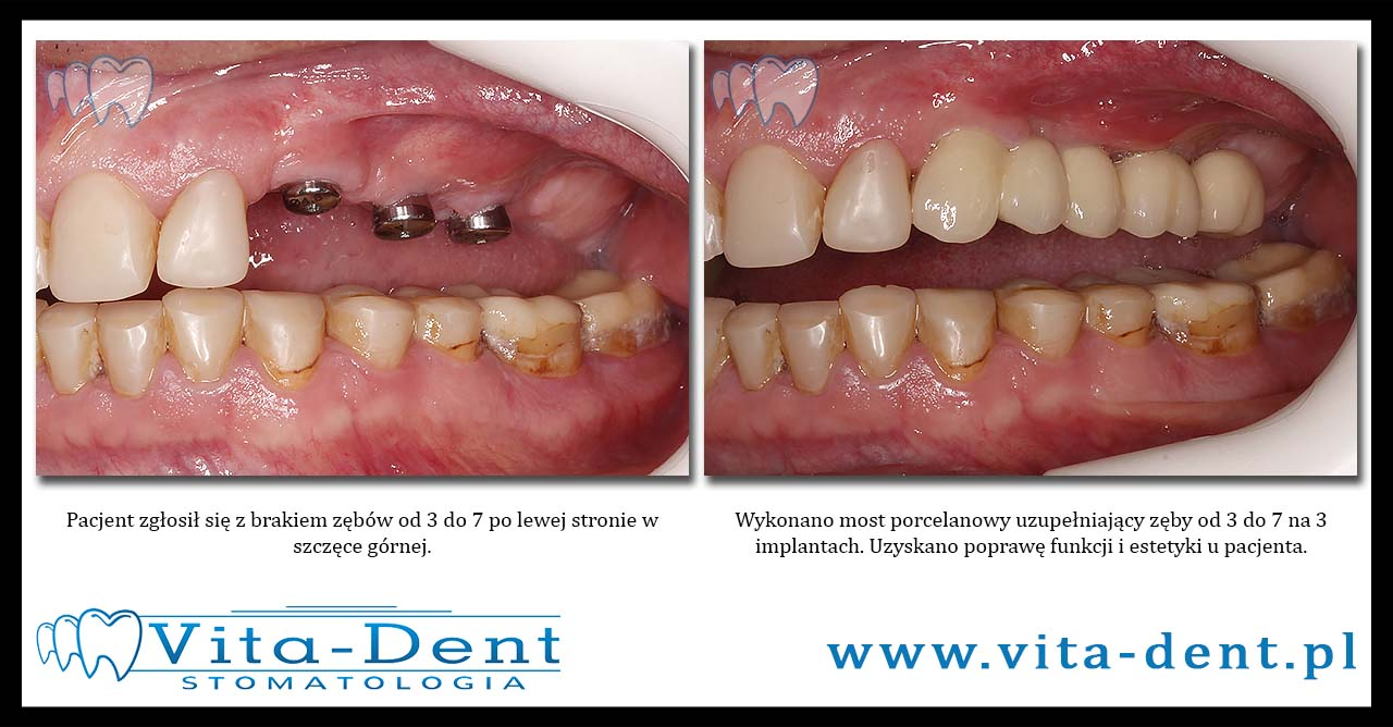 Reconstruction of lateral teeth, bridge on implants