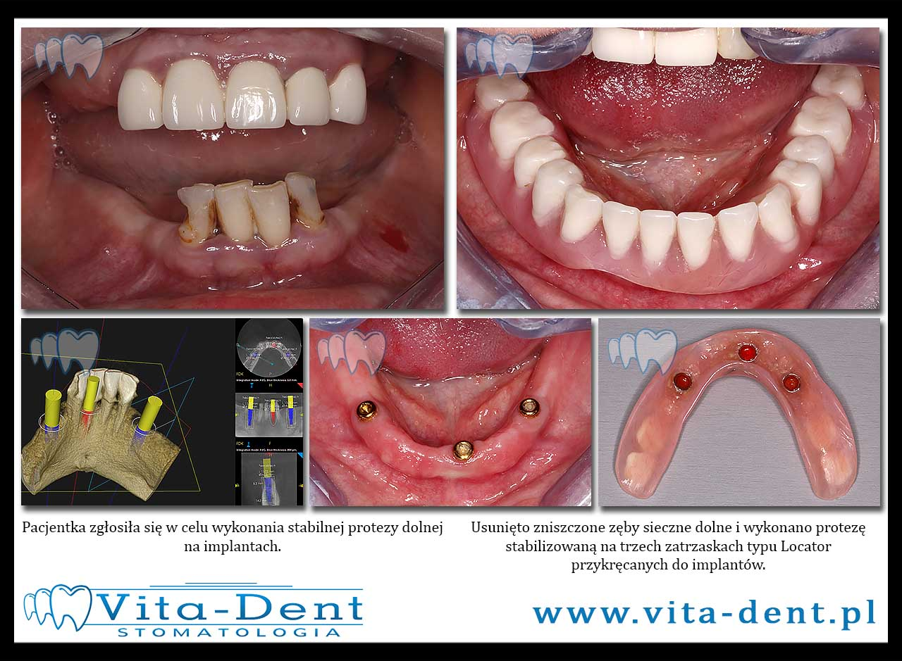 Prosthesis on implants, locator latches