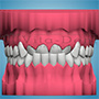 Orthodontic defects - crossbite