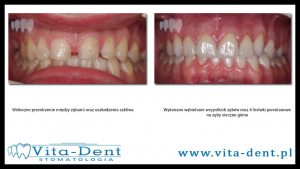 Porcelain veneers diastema