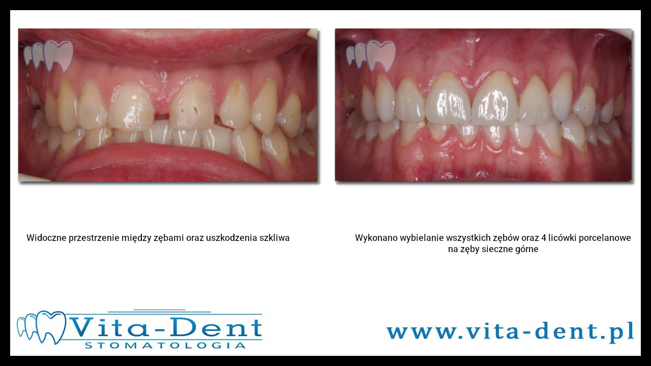 Porzellan Veneers diastema