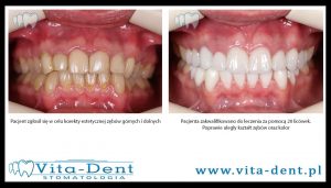 20 porcelain veneers