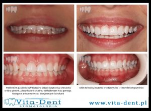 4 Composite veneers for upper incisal teeth