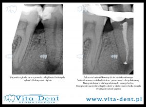 Root canal treatment - lower right five