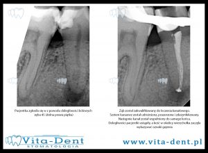 Leczenie kanałowe - dolna prawa piątka