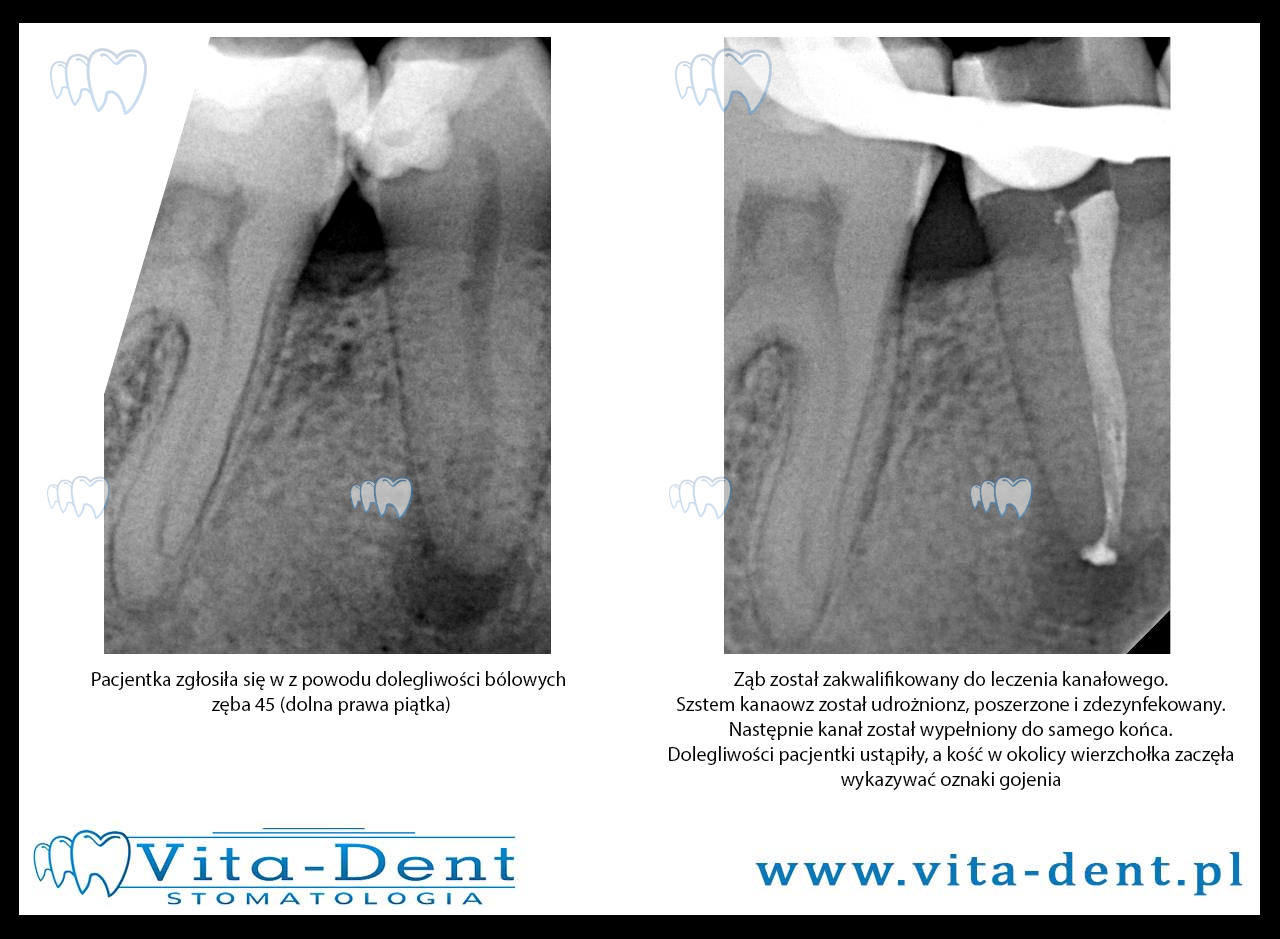Root canal treatment - lower right five