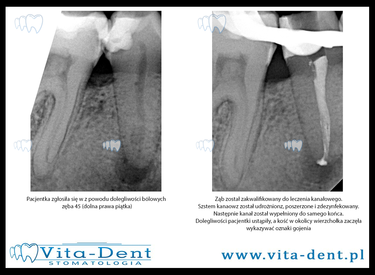 Leczenie kanałowe - dolna prawa piątka