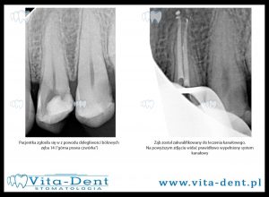 Root canal treatment - upper right four