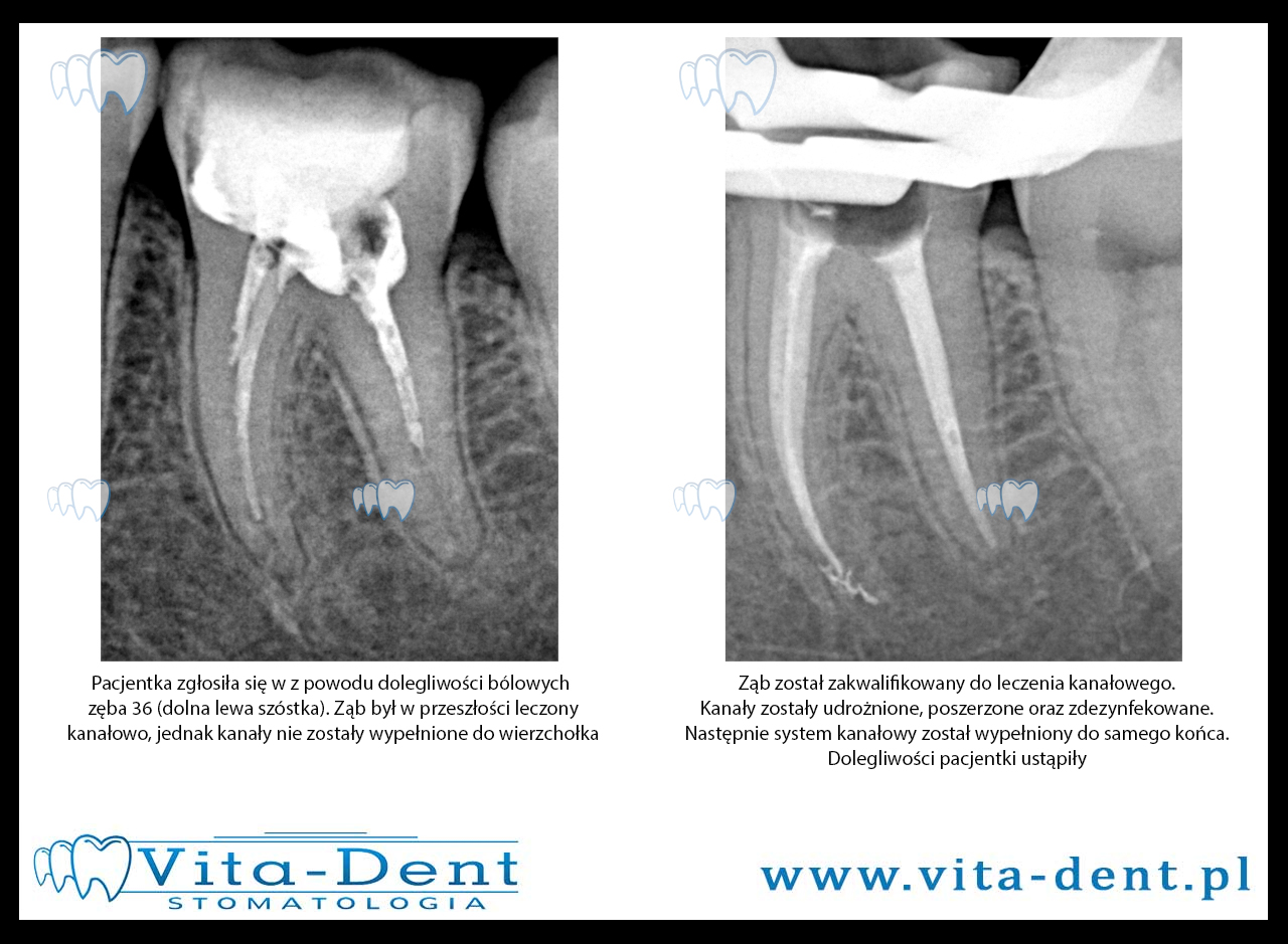 Repeated root canal treatment - lower left six