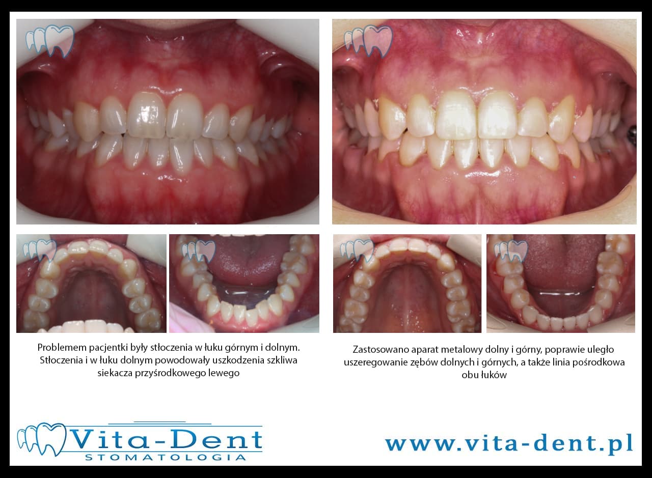 Verdrängung der unteren und oberen Zähne mit Korrektur der Medianlinie