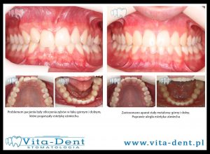 Verdrängung von oberen und unteren Zähnen - Verbesserung der Ästhetik