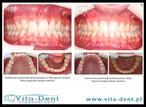 Stłoczenia zębów górnych i dolnych -poprawa estetyki