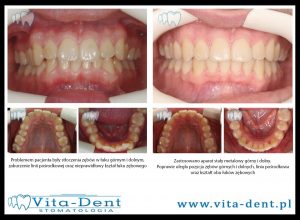 Verdrängung der oberen und unteren Zähne mit Korrektur der Medianlinie