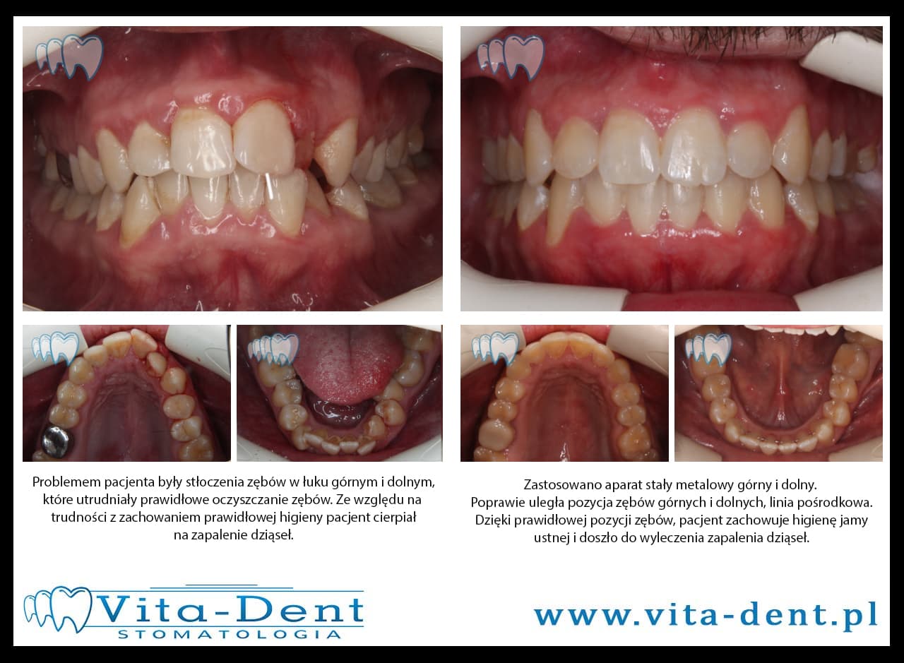 Verdrängung der oberen und unteren Zähne - Gingivitis
