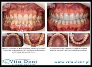 Crowded upper and lower teeth