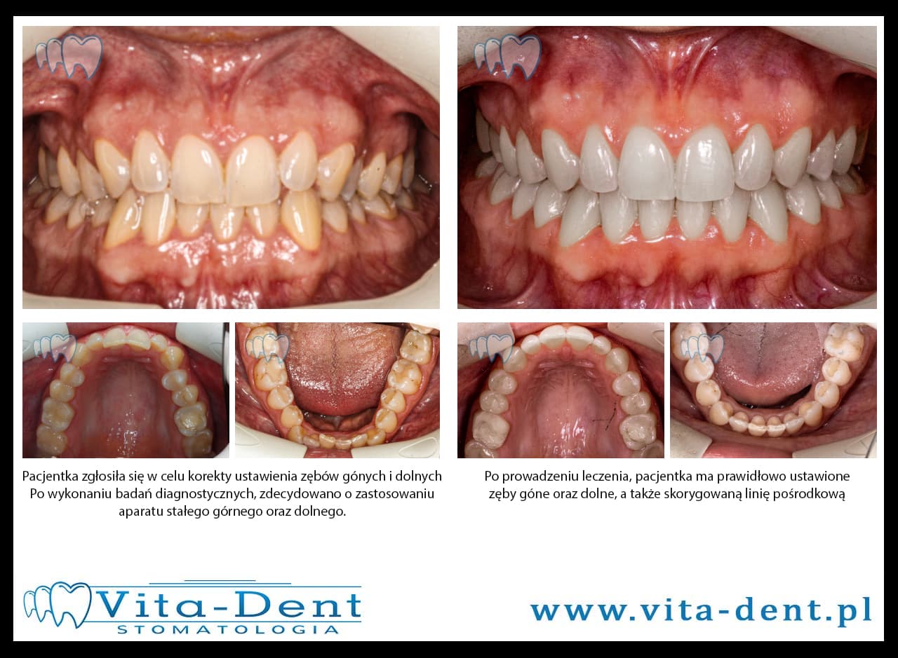 Crowding of upper and lower teeth