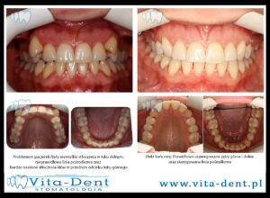 Stłoczone Górne Kły - Skuteczne Metody Ortodontyczne