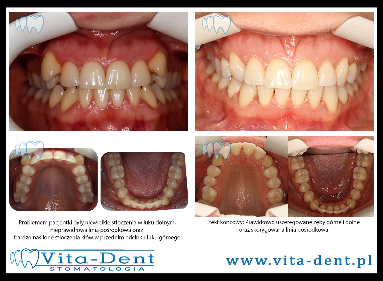 Stłoczone Górne Kły - Skuteczne Metody Ortodontyczne